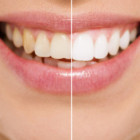 Vyhnite sa vŕtaniu zubov: Stačí dodržiavať 8 jednoduchých pravidiel